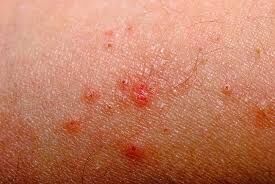 Аллергия или сыпь как определить thumbnail